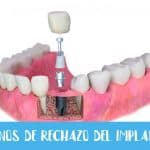 imagen de implante dental siendo colocado